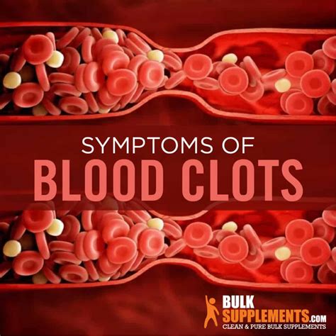 clotsiti|Blood Clots: Symptoms, Causes, and Treatment .
